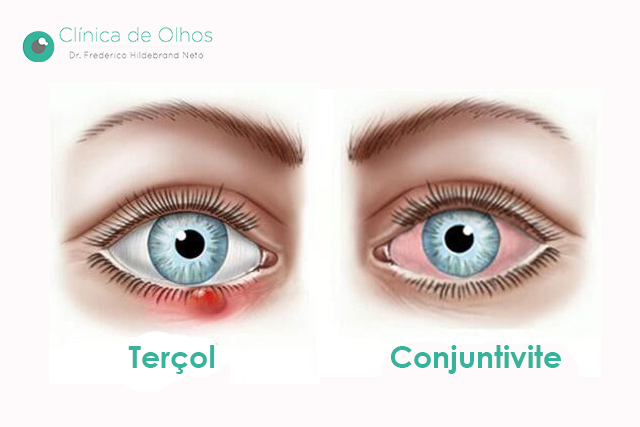 Qual a diferença entre Calázio ou Hordéolo (Terçol)? Bolinha no